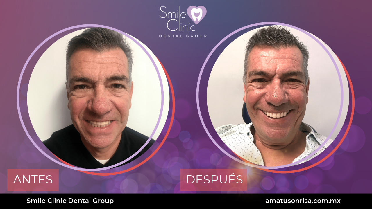 ANTES Y DESPUES-10