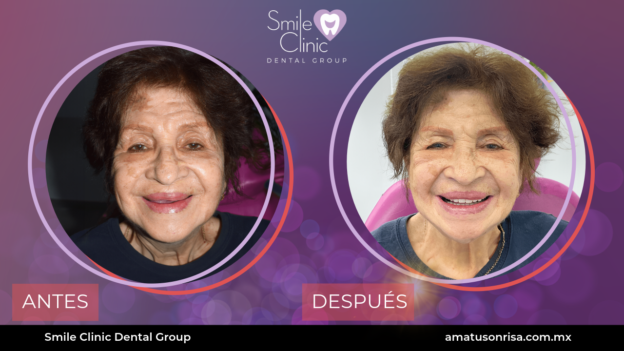 ANTES Y DESPUES-11