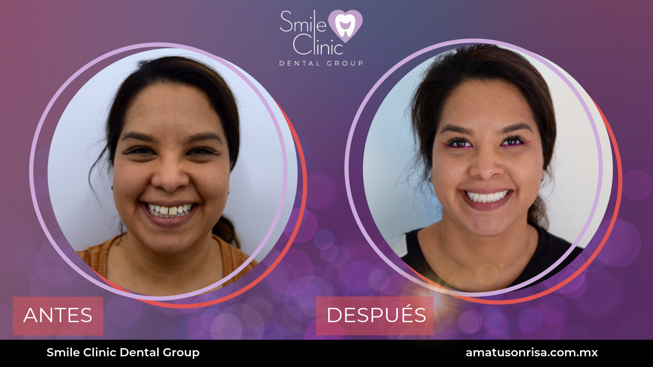 ANTES Y DESPUES-12