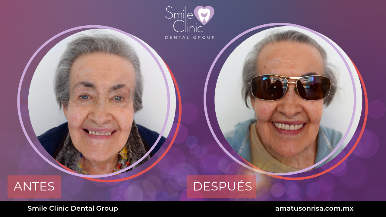 ANTES Y DESPUES-13