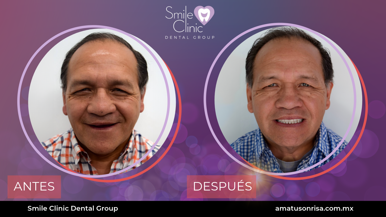 ANTES Y DESPUES-14