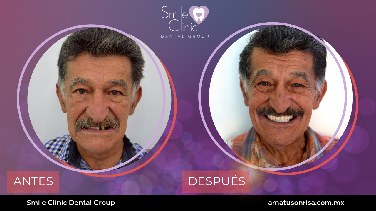 ANTES Y DESPUES-15