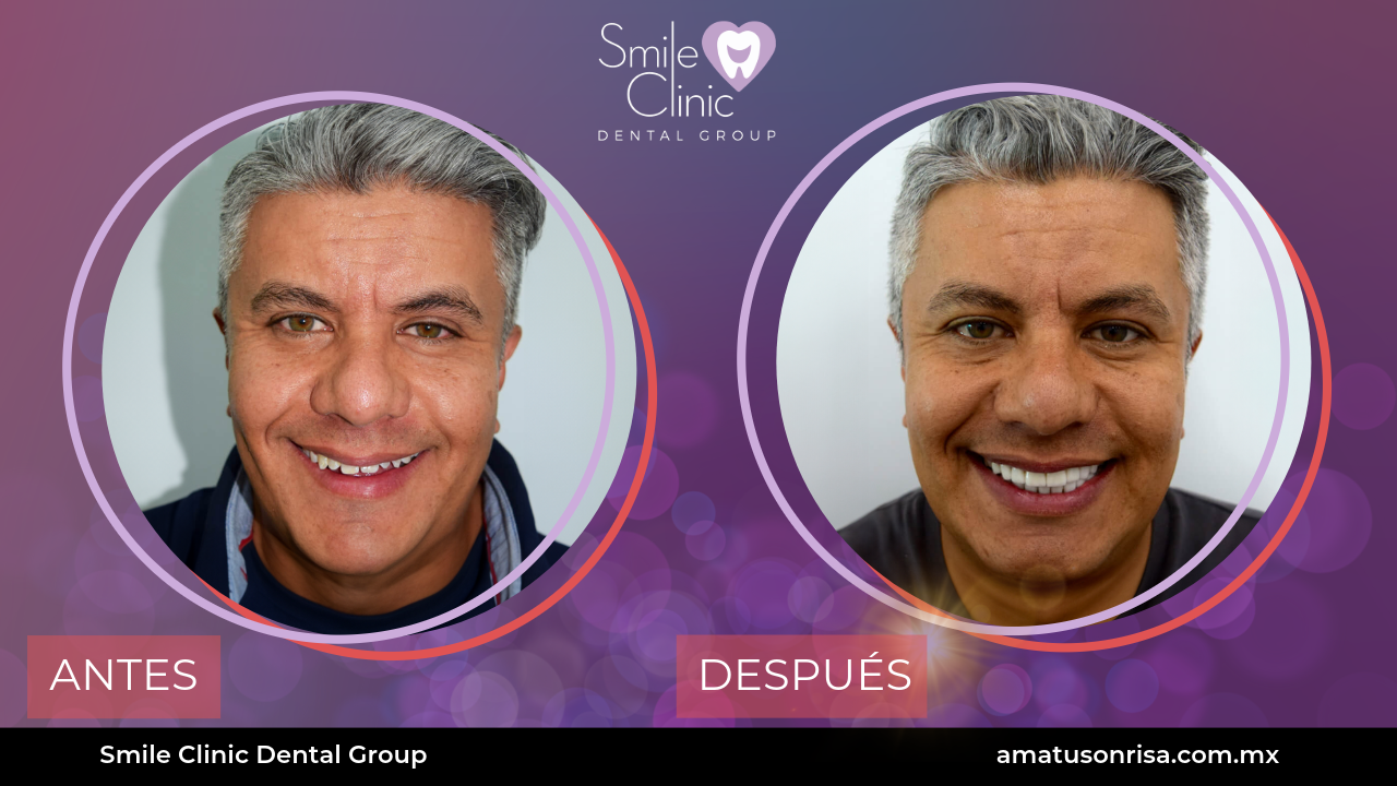 ANTES Y DESPUES-16