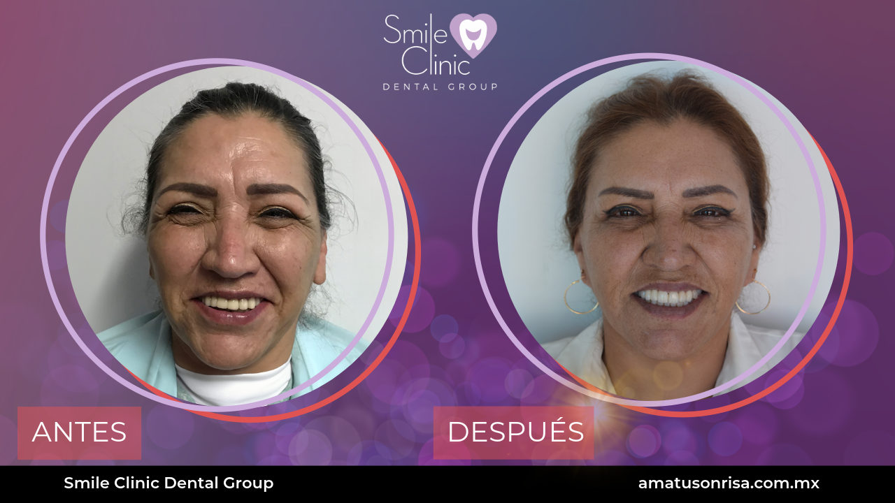 ANTES Y DESPUES-2