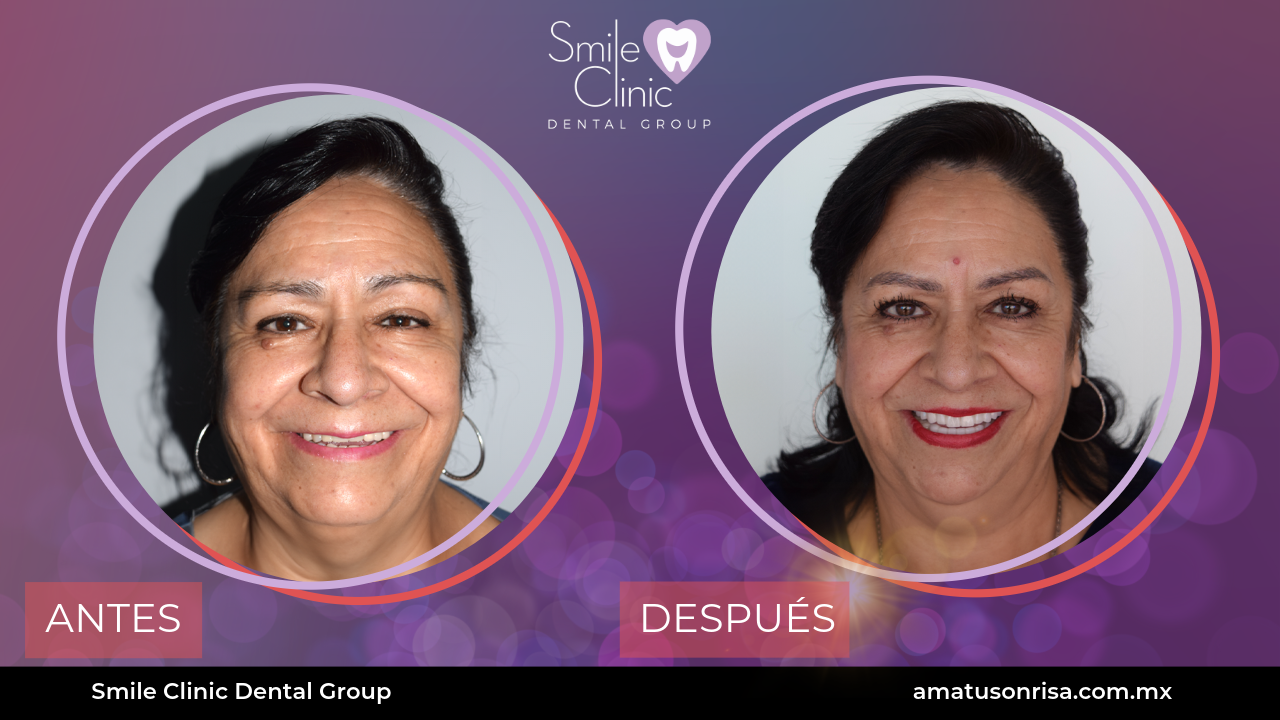 ANTES Y DESPUES-3