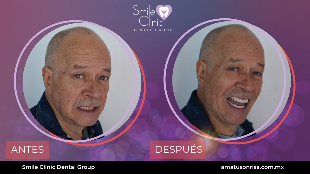 ANTES Y DESPUES-4