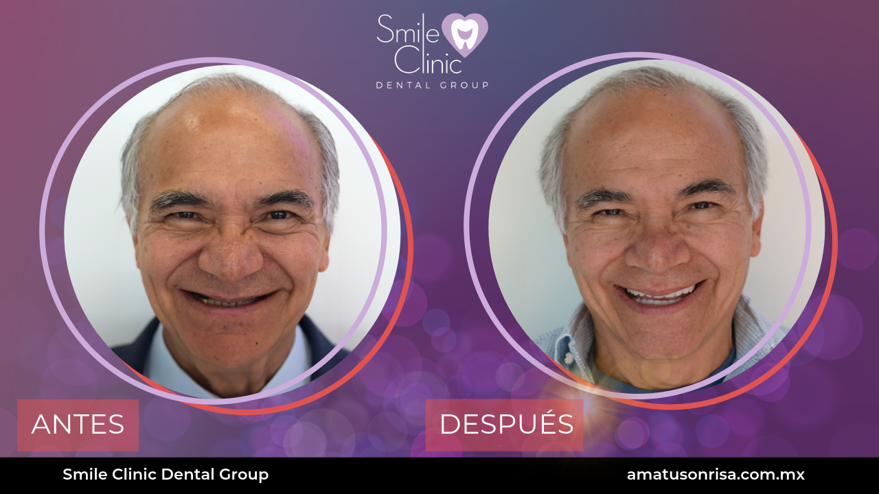 ANTES Y DESPUES-5
