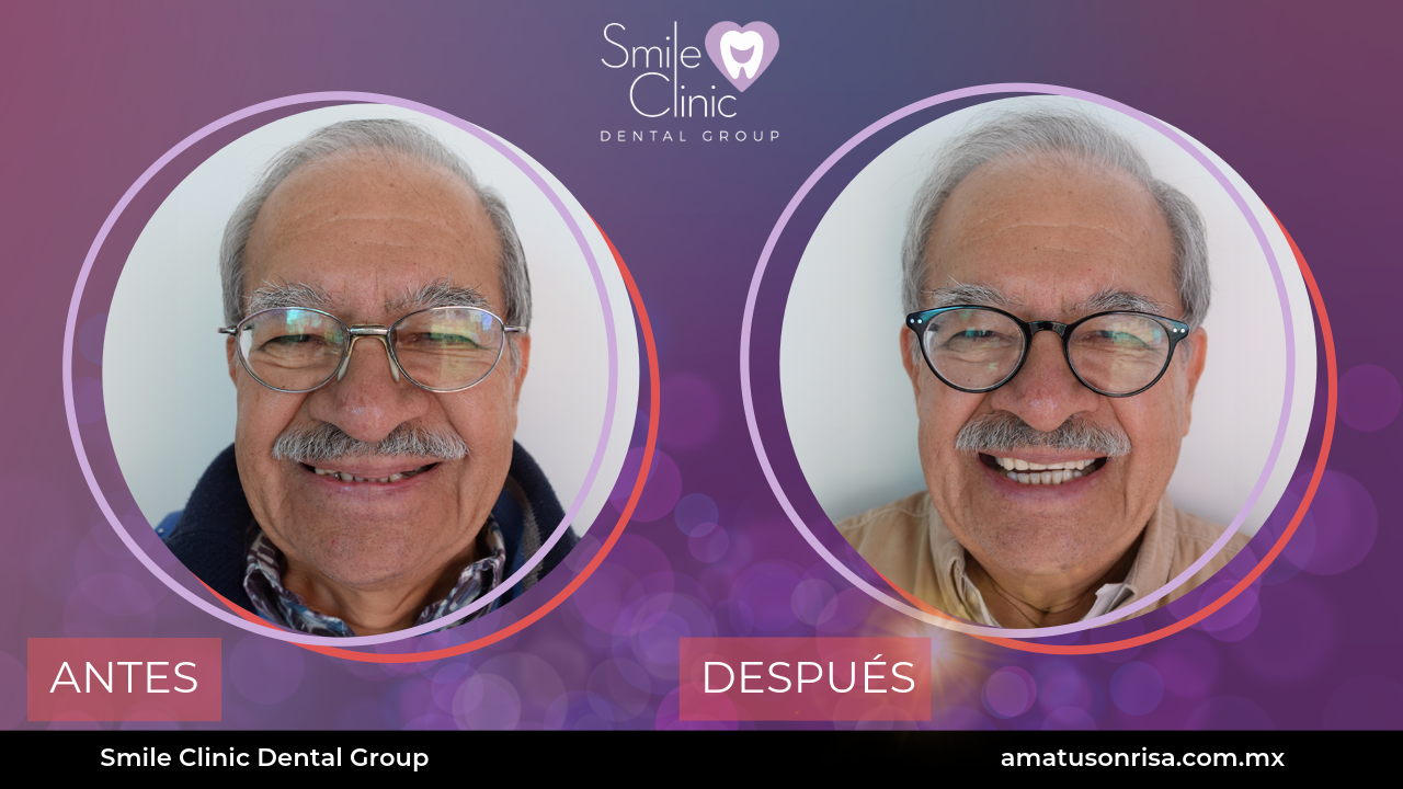 ANTES Y DESPUES-6