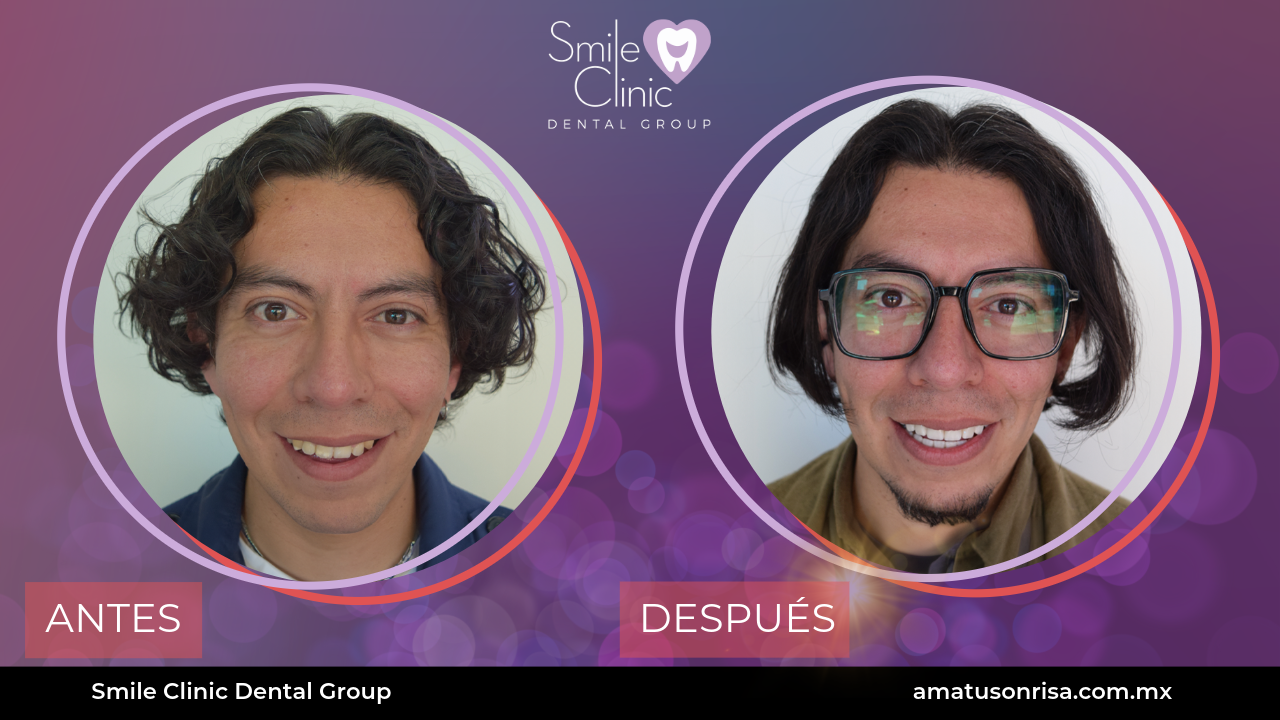 ANTES Y DESPUES-7