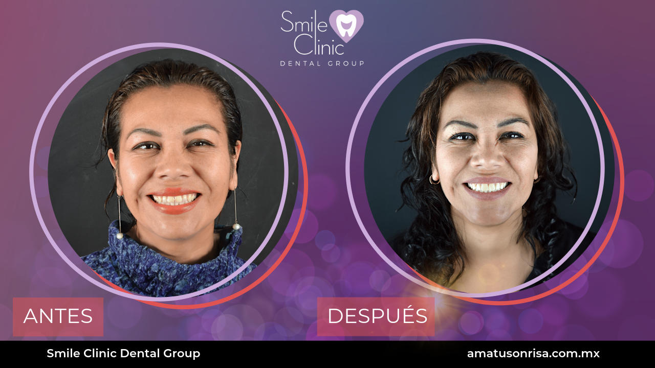 ANTES Y DESPUES-8