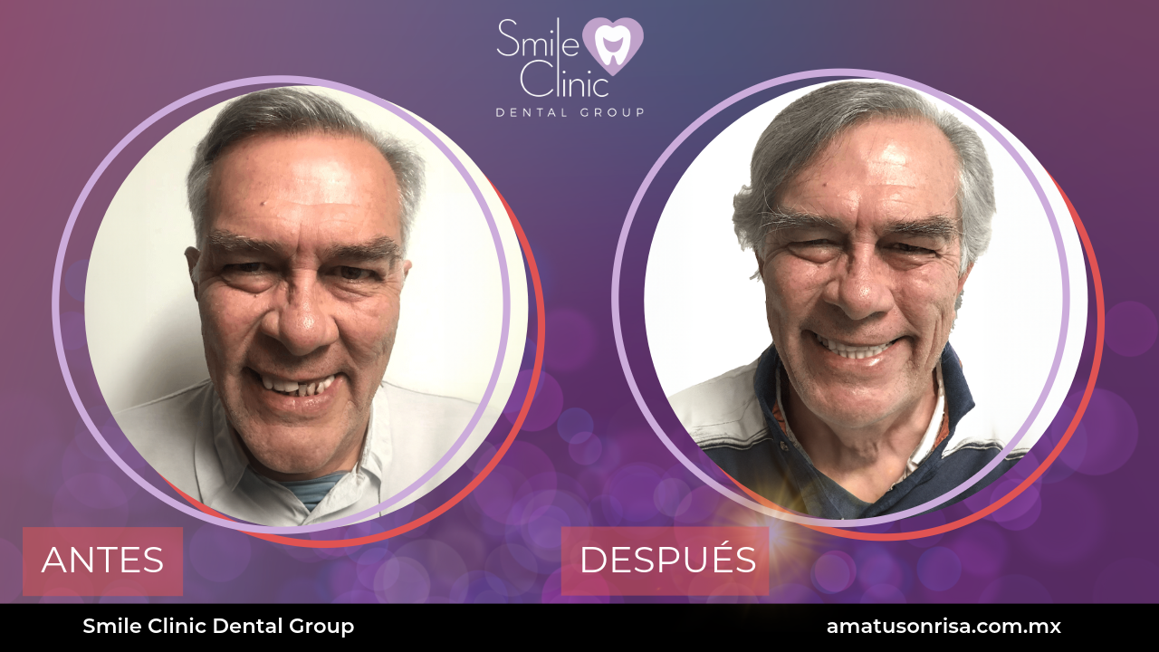 ANTES Y DESPUES-9