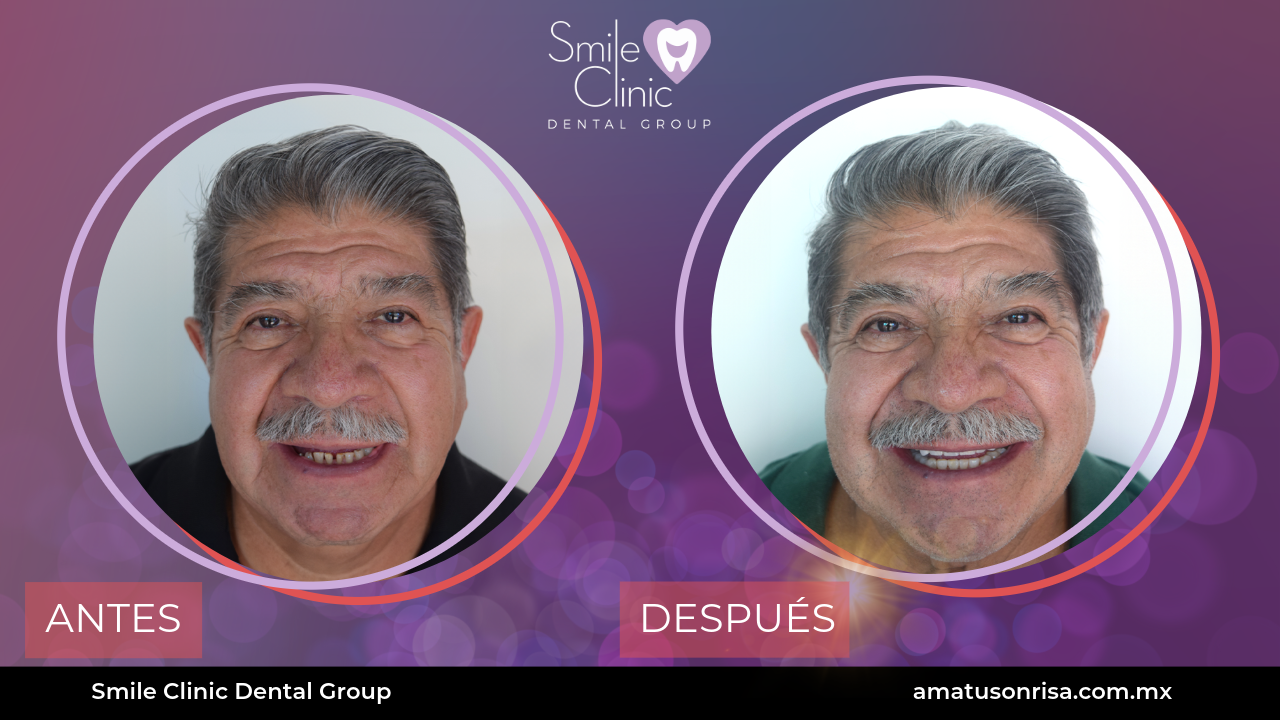 ANTES Y DESPUES
